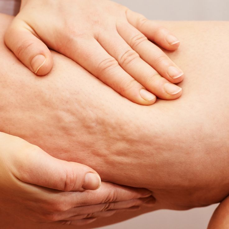 Anticellulite massage